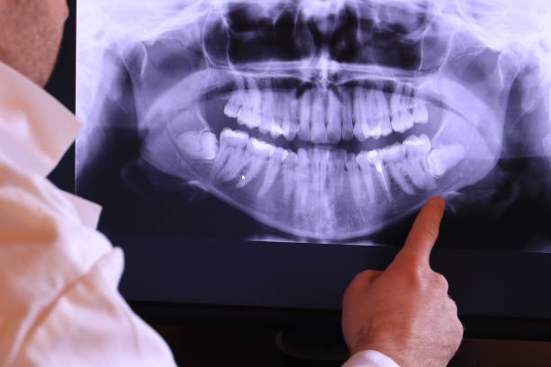 Best Emergency Dental Extractions in Carbondale, PA